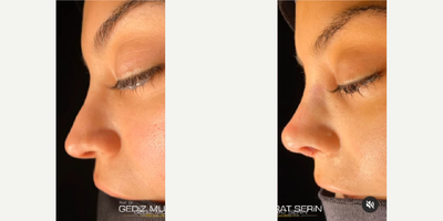 Revision Rhinoplasty before and after photo