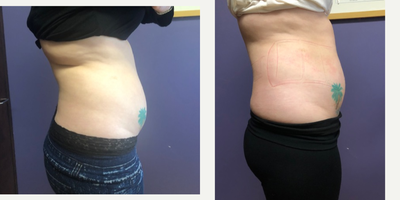 SculpSure before and after photo