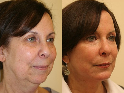 Chin Implant before and after photo