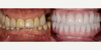 Dental Implants before and after photo
