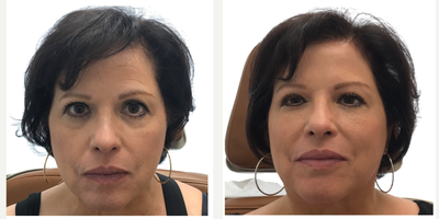 Dermal Fillers before and after photo