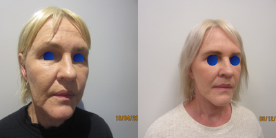 Eyelid Surgery before and after photo
