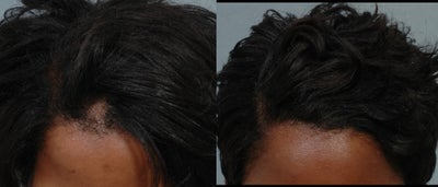 FUE Hair Transplant before and after photo