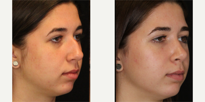Rhinoplasty before and after photo