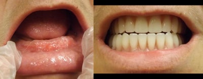 Smile Makeover before and after photo