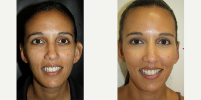 Ear Surgery before and after photo
