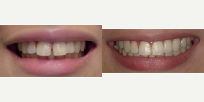 Invisalign before and after photo