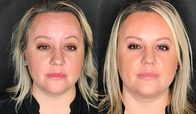 Botox before and after photo