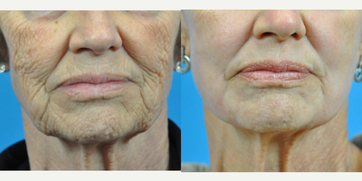 CO2 Laser before and after photo