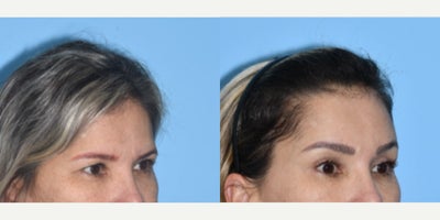 Eyelid Surgery before and after photo