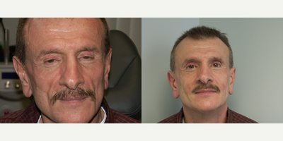 Facial Fat Transfer before and after photo