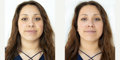 HydraFacial before and after photo