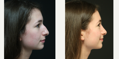 Rhinoplasty before and after photo