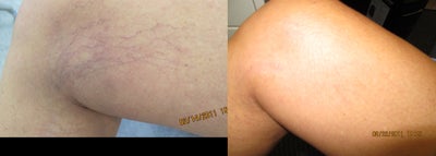 Sclerotherapy before and after photo