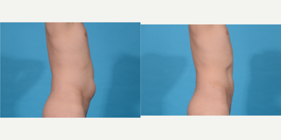 Tumescent Liposuction before and after photo