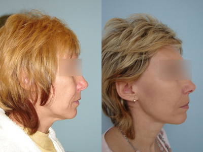 Facelift before and after photo