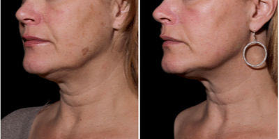 Laser Resurfacing before and after photo
