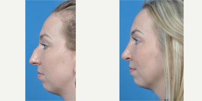 Rhinoplasty before and after photo
