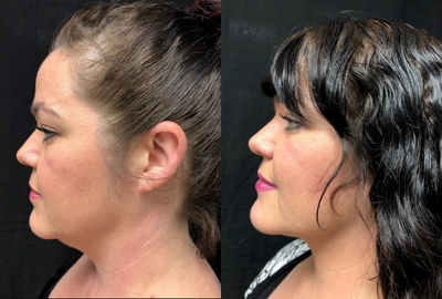 Thread Lift before and after photo