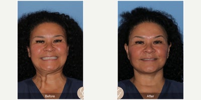 Botox before and after photo
