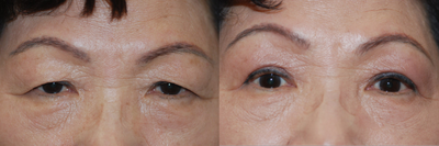 Double Eyelid Surgery before and after photo