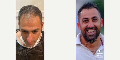 Hair Transplant before and after photo