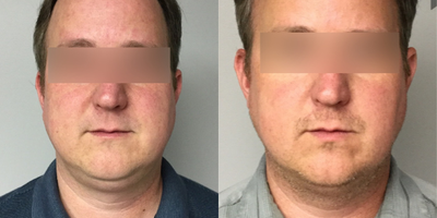 Kybella before and after photo