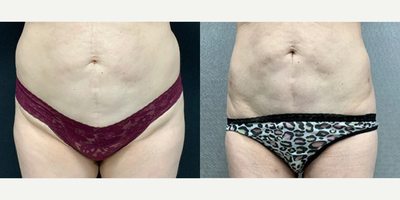 Liposuction before and after photo
