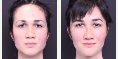 Adam's Apple Reduction before and after photo