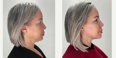 Facelift before and after photo