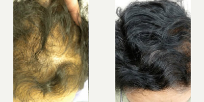 Hair Transplant before and after photo