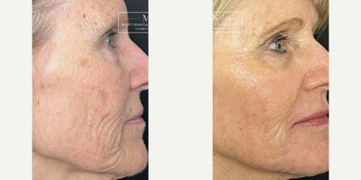 Laser Resurfacing before and after photo