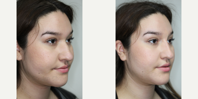 Nonsurgical Nose Job before and after photo