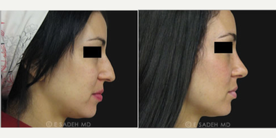 Rhinoplasty before and after photo