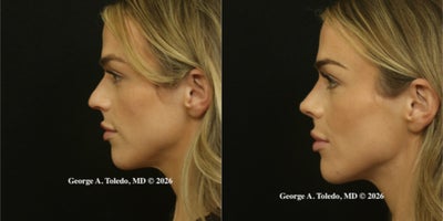 Rhinoplasty before and after photo