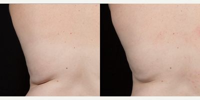 SculpSure before and after photo