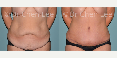 Tummy Tuck before and after photo