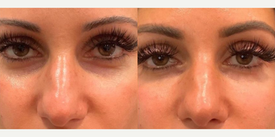 Dermal Fillers before and after photo