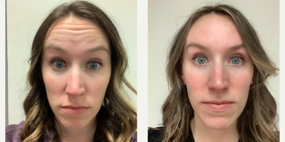 Dysport before and after photo
