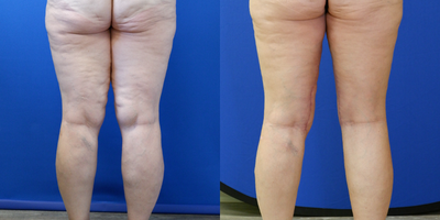 Liposuction before and after photo