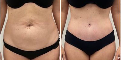 Tummy Tuck before and after photo