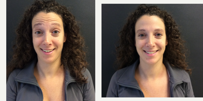 Botox before and after photo