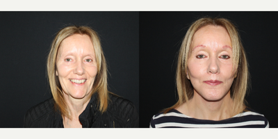 Mini Facelift before and after photo