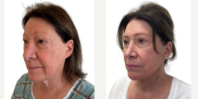 Neck Lift before and after photo
