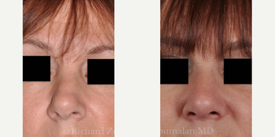 Revision Rhinoplasty before and after photo
