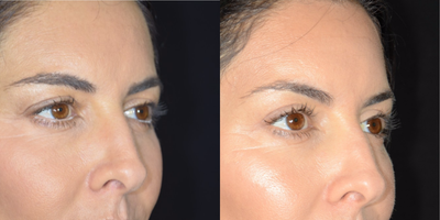 Eyelid Surgery before and after photo