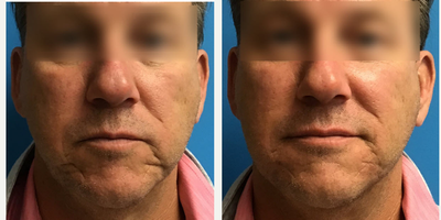 Juvederm before and after photo