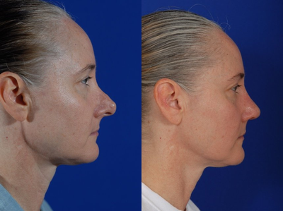 Revision Rhinoplasty before and after photo