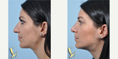 Rhinoplasty before and after photo