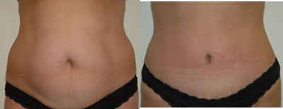Tummy Tuck before and after photo